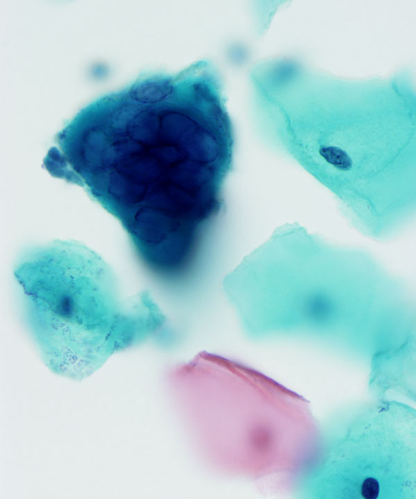 02 : Gynecologic Herpes Virus