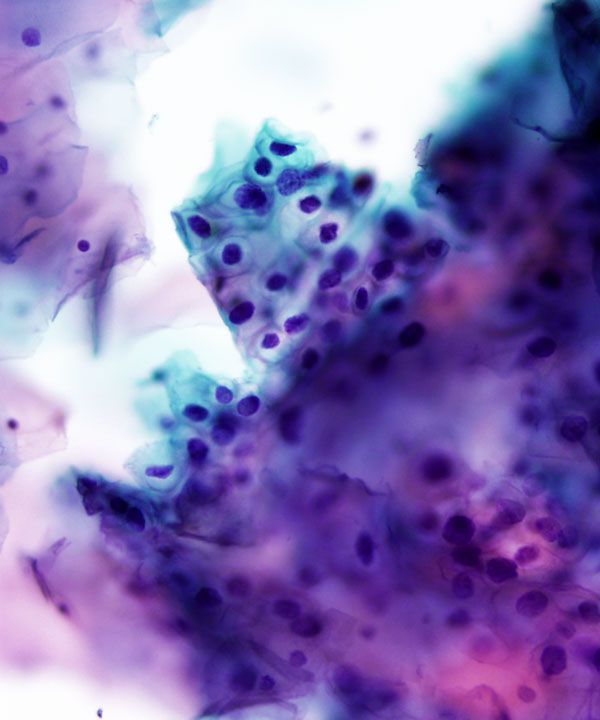 image showing 'Low grade squamous intraepithelial lesion (LSIL)'