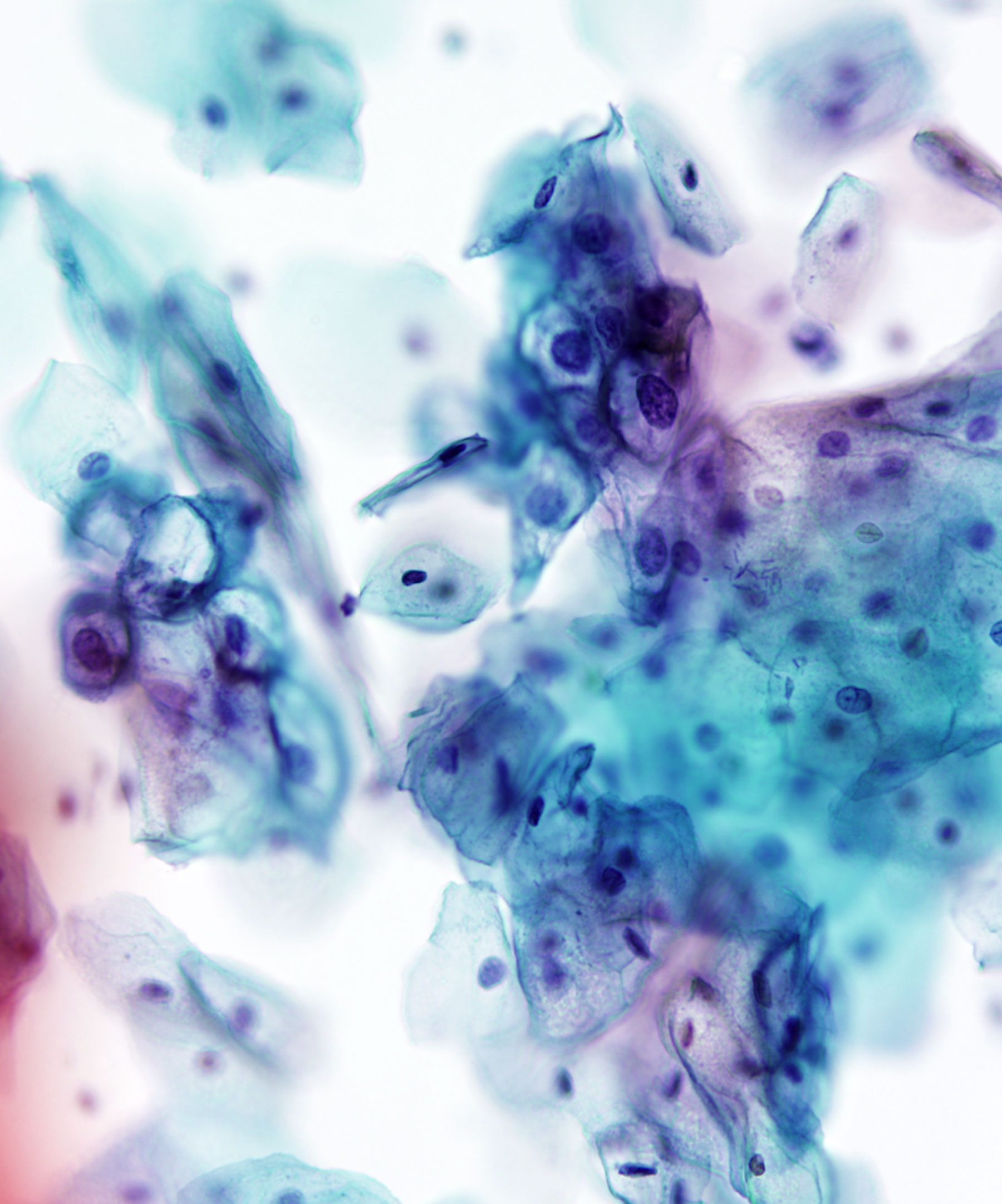 02 : Gynecologic Cytology LSIL