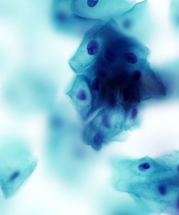 03 : Gynecologic Cytology LSIL