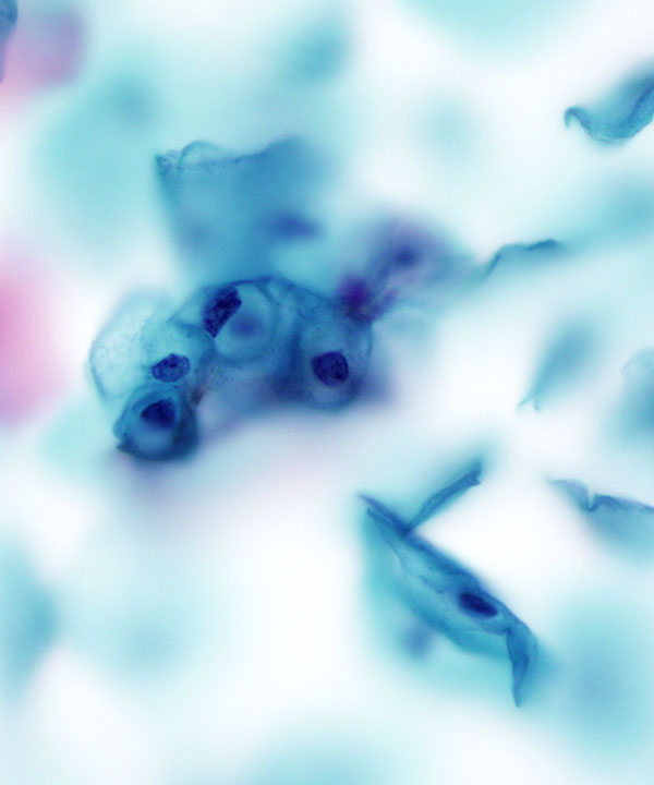 04 : Gynecologic Cytology LSIL