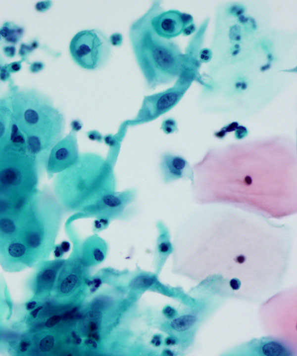 image showing 'Radiation Atypia'