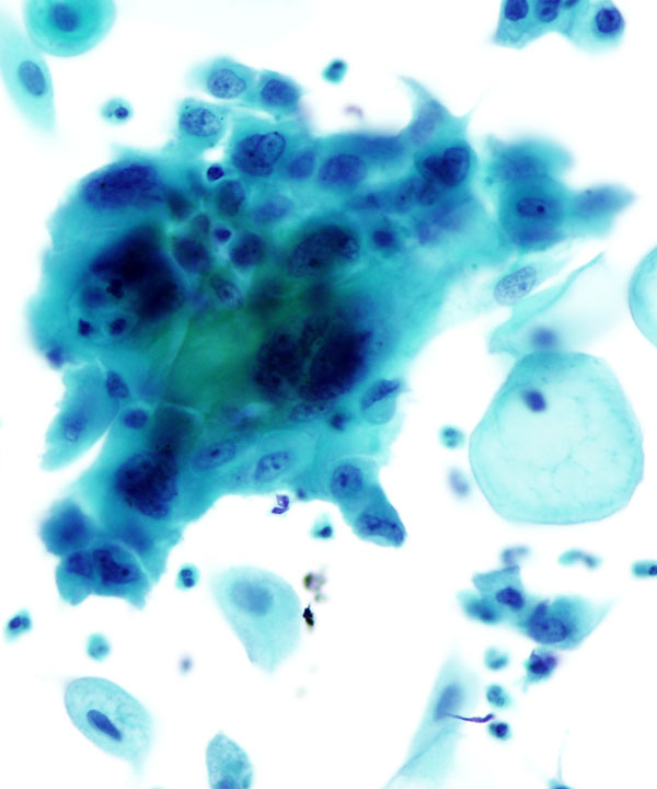 02 : Gynecologic Cytology Radiation Atypia