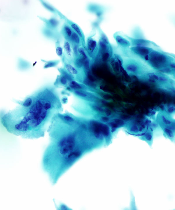 03 : Gynecologic Cytology Radiation Atypia