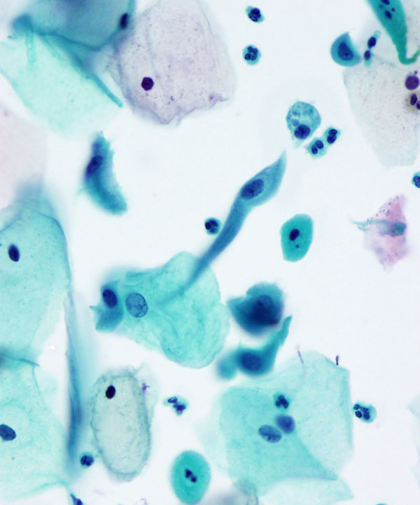 04 : Gynecologic Cytology Radiation Atypia