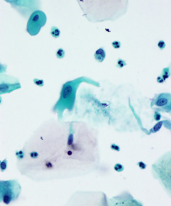 05 : Gynecologic Cytology Radiation Atypia