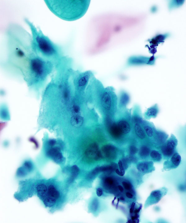 06 : Gynecologic Cytology Radiation Atypia
