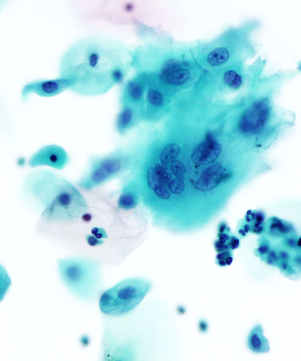 07 : Gynecologic Cytology Radiation Atypia