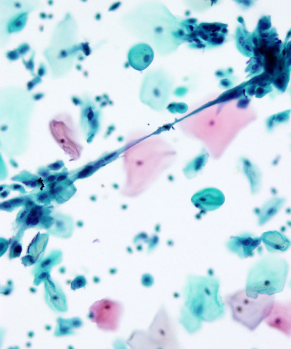 08 : Gynecologic Cytology Radiation Atypia