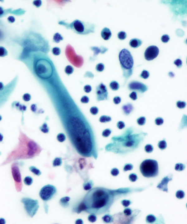 02 : Gynecologic Cytology Squamous Cell Carcinoma