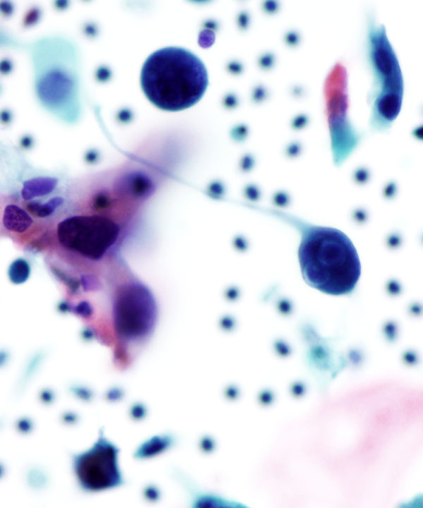 03 : Gynecologic Cytology Squamous Cell Carcinoma