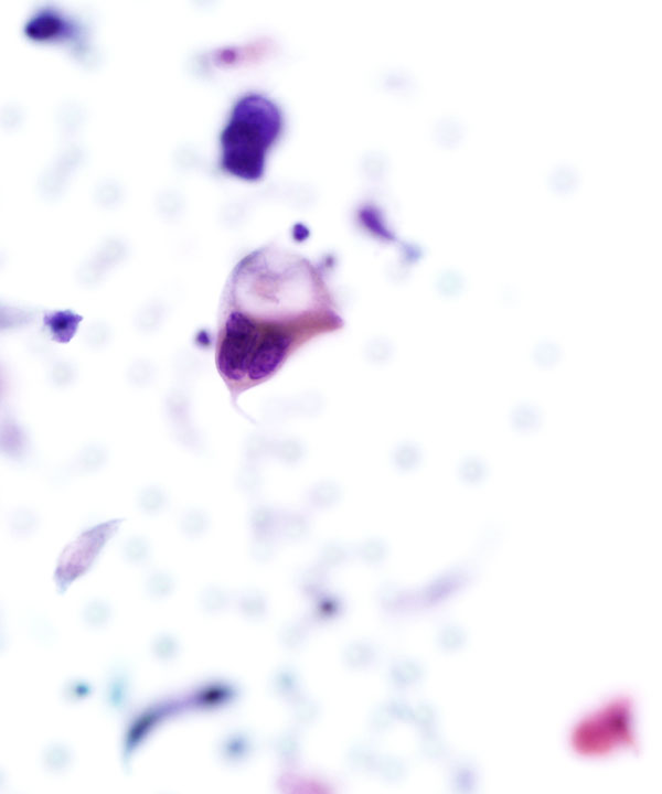 05 : Gynecologic Cytology Squamous Cell Carcinoma