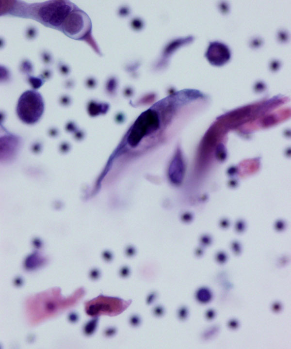 08 : Gynecologic Cytology Squamous Cell Carcinoma