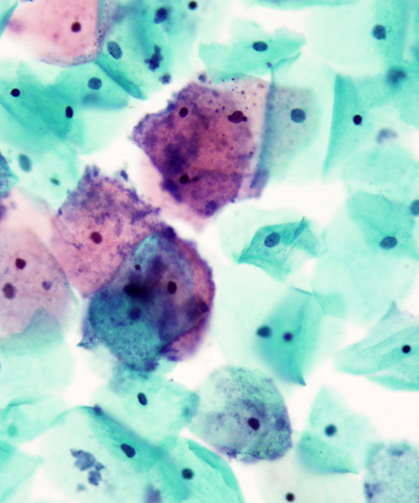 image showing 'Bacterial Vaginosis'