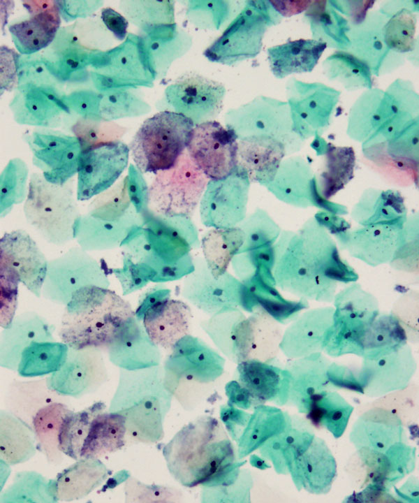02 : Gynecologic Cytology Bacterial Vaginosis