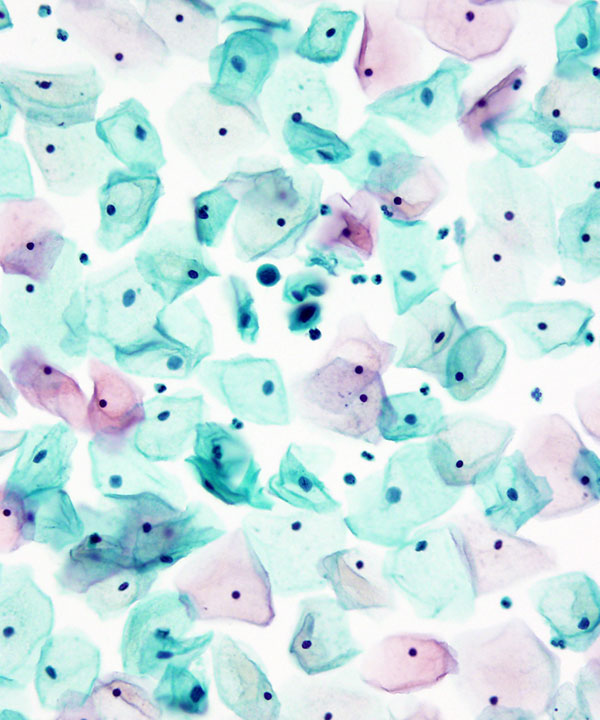 01 : Gynecologic HSIL