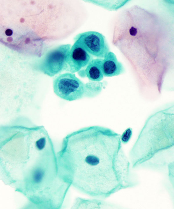 03 : Gynecologic HSIL