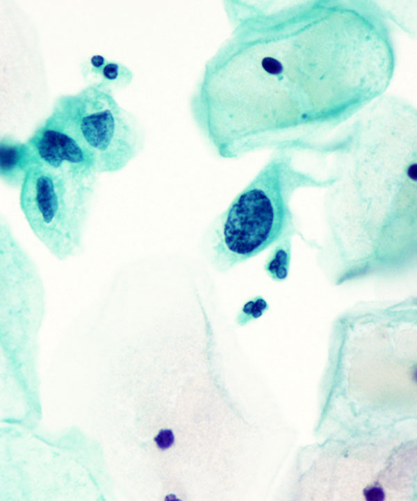 04 : Gynecologic HSIL
