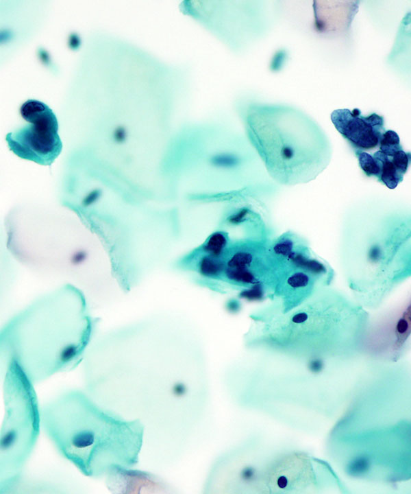 05 : Gynecologic HSIL
