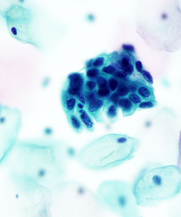 06 : Gynecologic HSIL