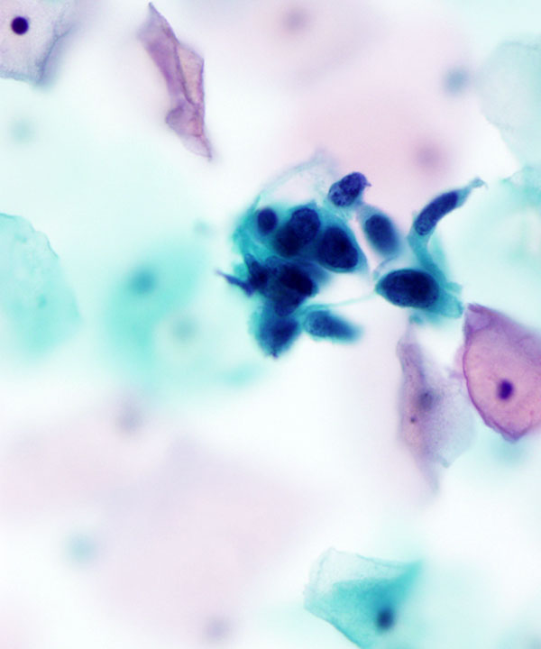 07 : Gynecologic HSIL