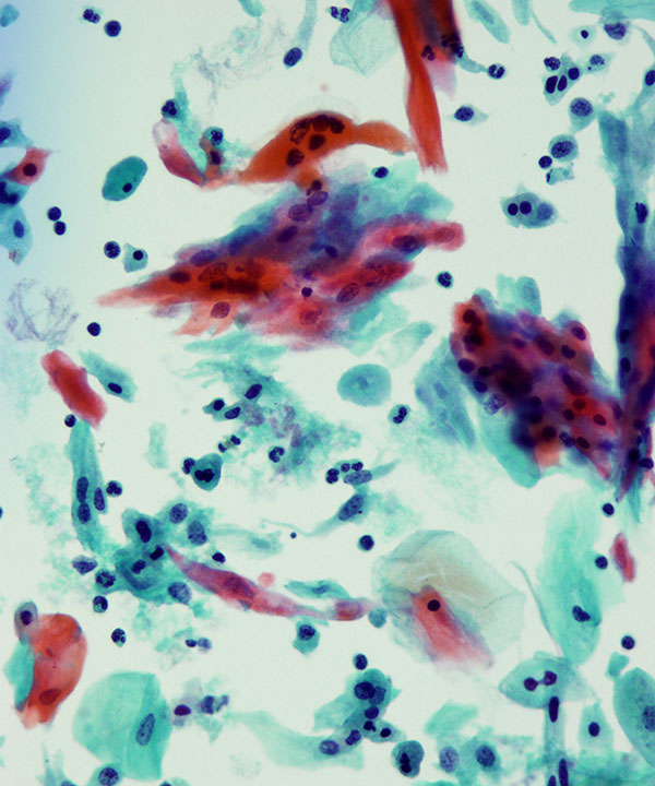 image showing 'High grade squamous intraepithelial lesion (HSIL)'