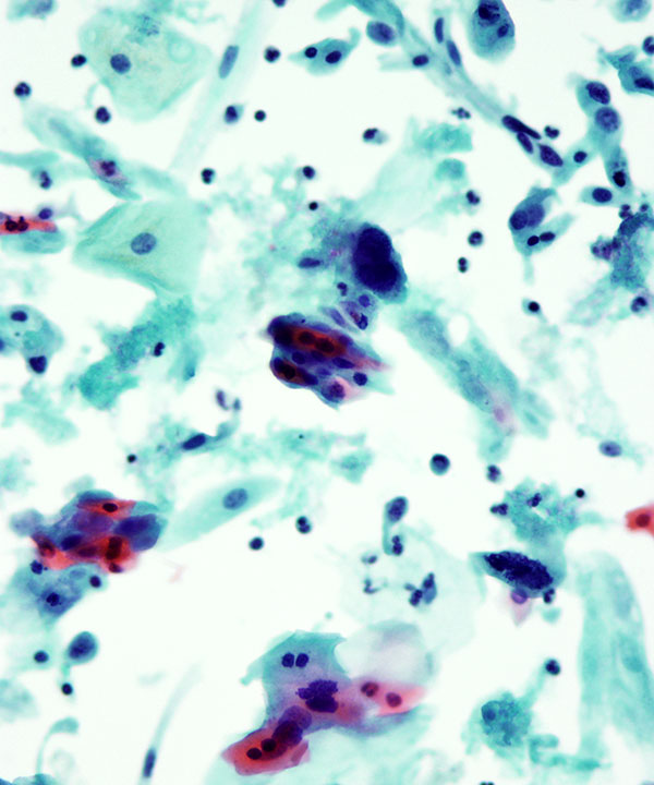 09 : Gynecologic HSIL