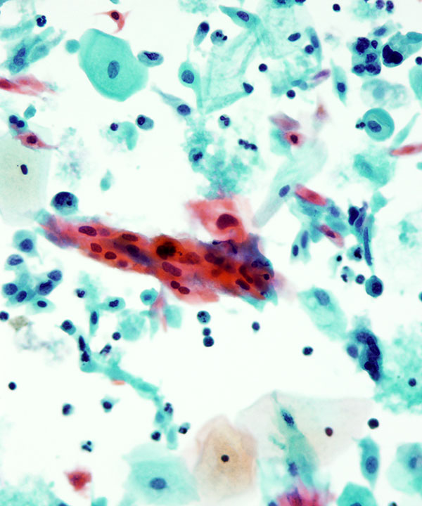 10 : Gynecologic HSIL