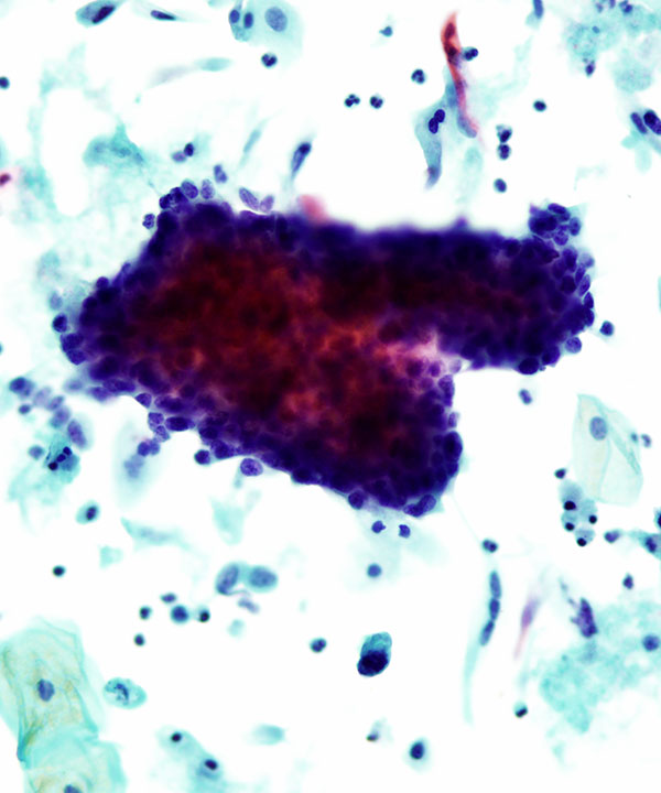 11 : Gynecologic HSIL