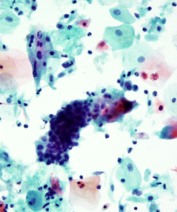 12 : Gynecologic HSIL