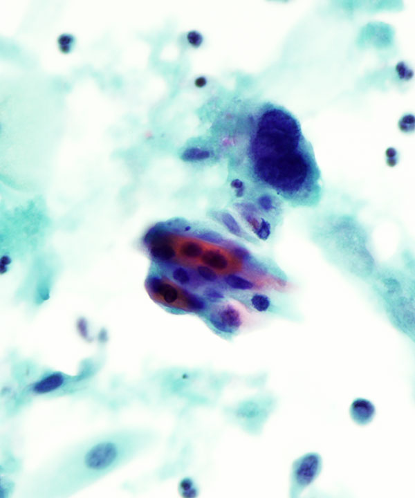 13 : Gynecologic HSIL