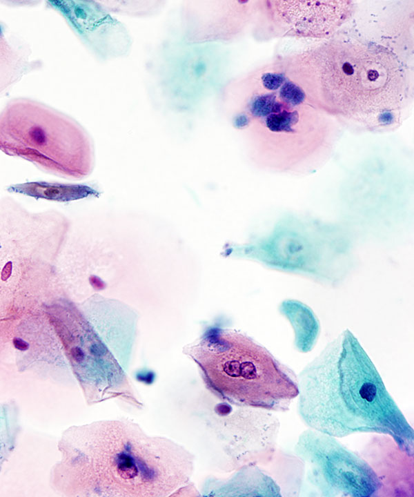 02 : Gynecologic Trichomonas