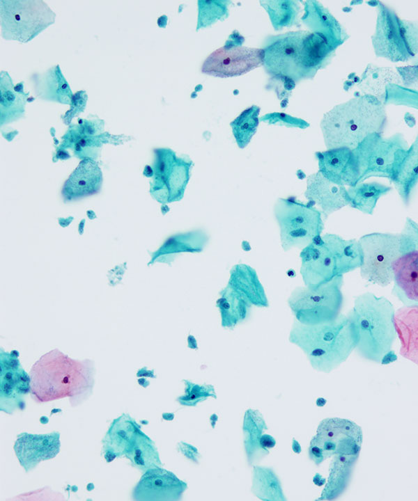 03 : GynecologicTrichomonas