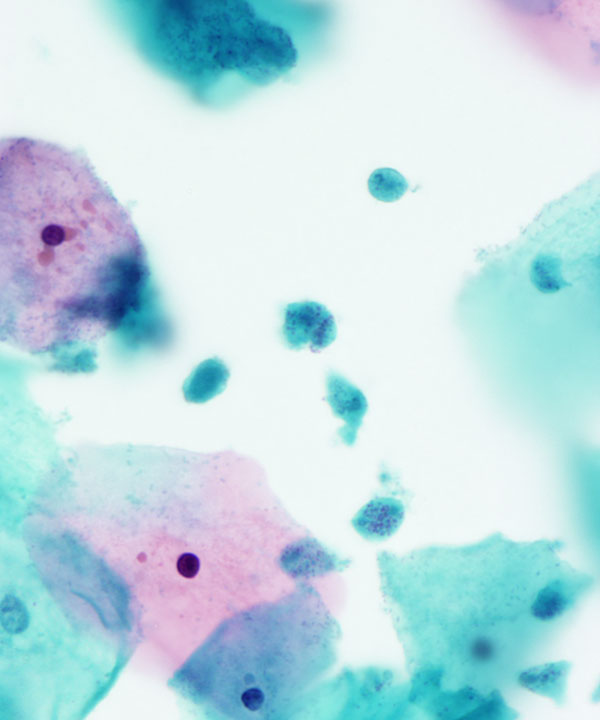 04 : GynecologicTrichomonas