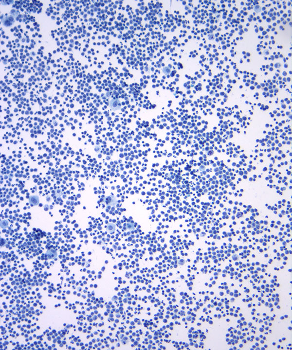 03 : Hem Burkitt Lymphoma