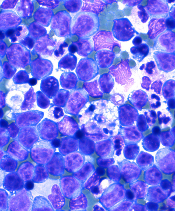 05 : Hem Burkitt Lymphoma