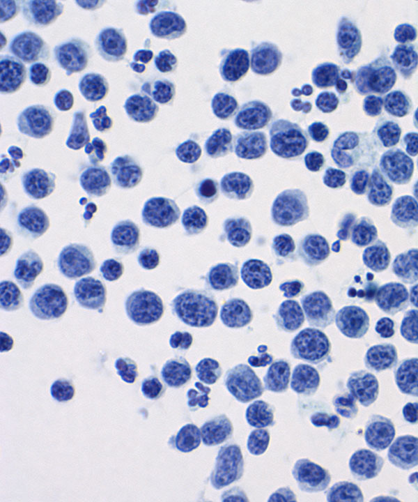 06 : Hem Burkitt Lymphoma