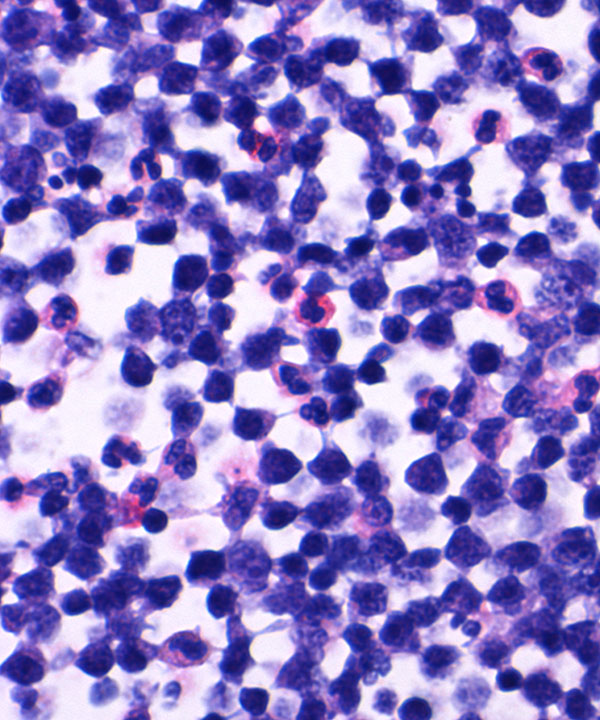 07 : Hem Burkitt Lymphoma