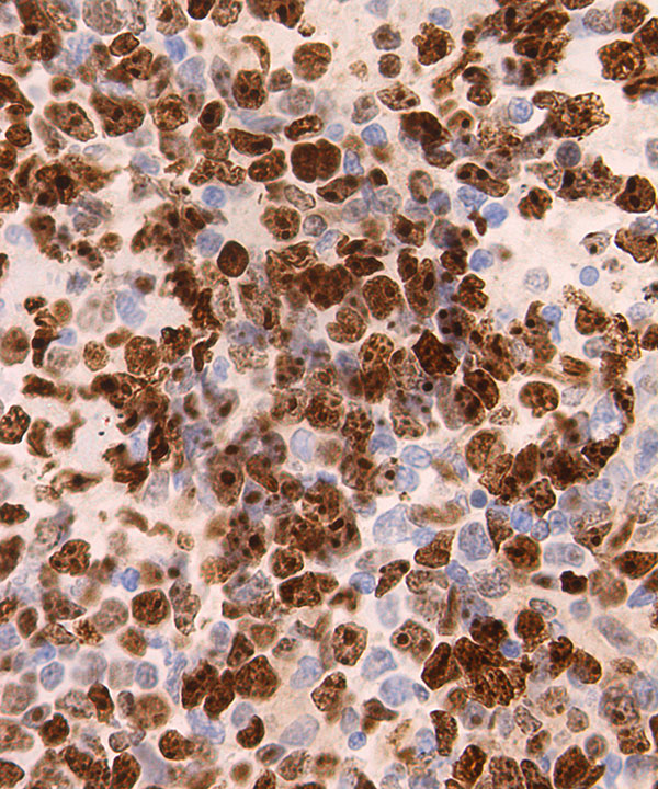 08 : Hem Burkitt Lymphoma