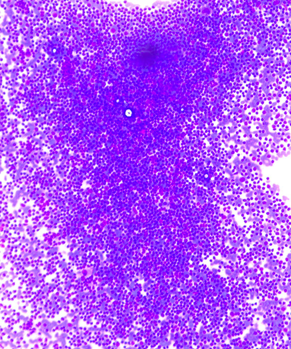image showing 'Chronic Lymphocytic Leukemia/Small Lymphocytic Lymphoma'
