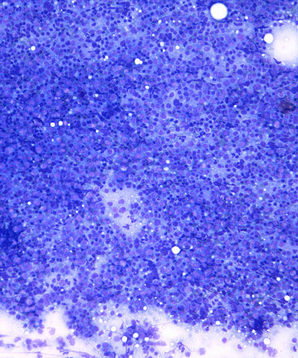 image showing 'Follicular Lymphoma'