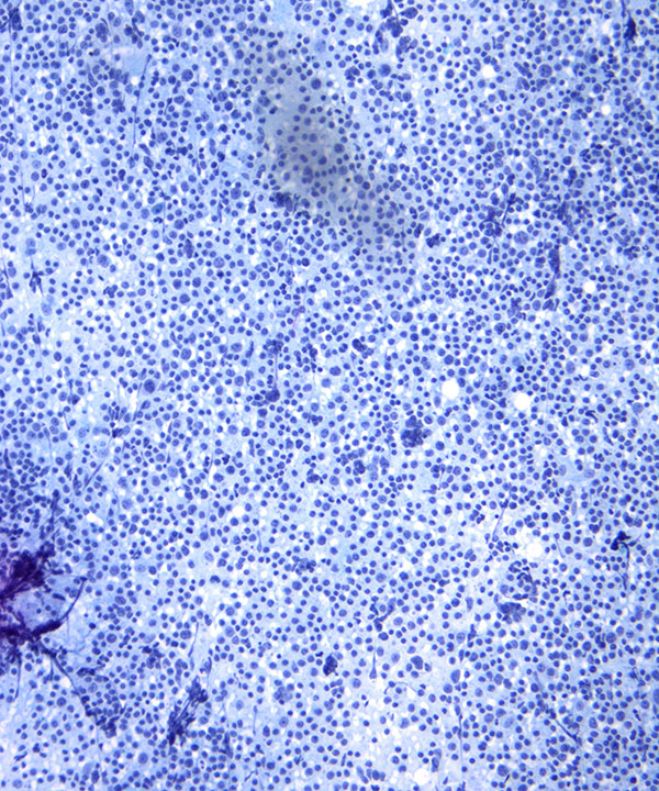 02 : Hem Follicular Lymphoma