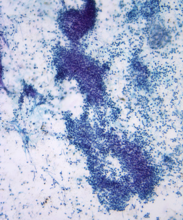 03 : Hem Follicular Lymphoma