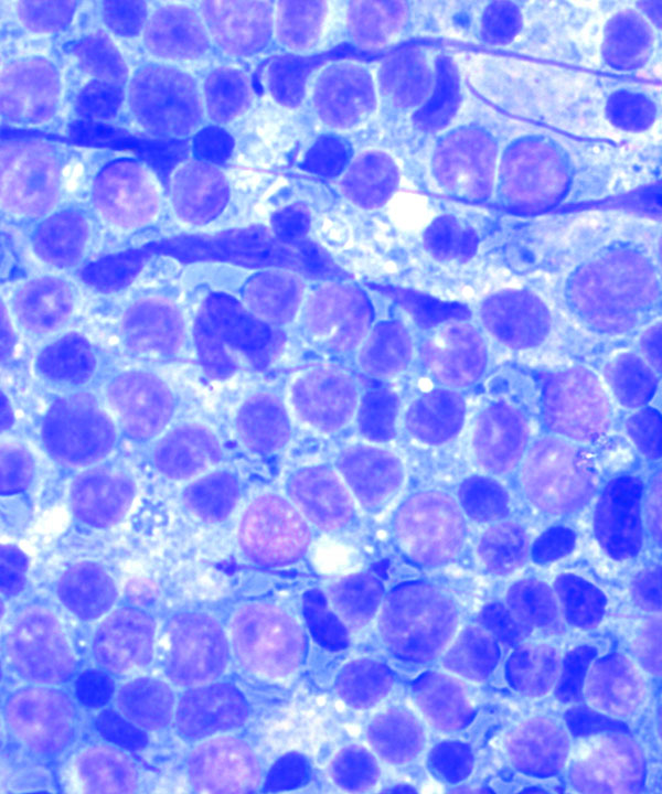 04 : Hem Follicular Lymphoma