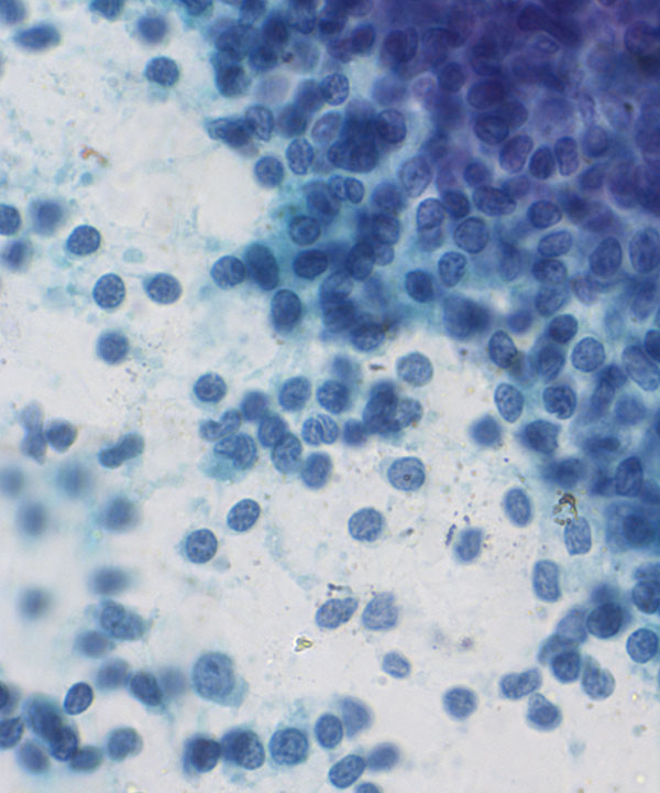 06 : Hem Follicular Lymphoma