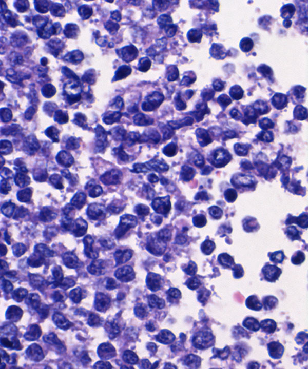07 : Hem Follicular Lymphoma