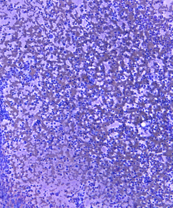 image showing 'Nodal Marginal Zone Lymphoma'
