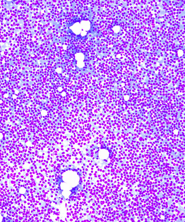 image showing 'Mantle Cell Lymphoma'