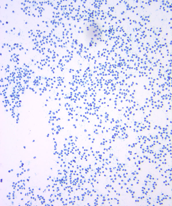02 : HemMantle Cell Lymphoma