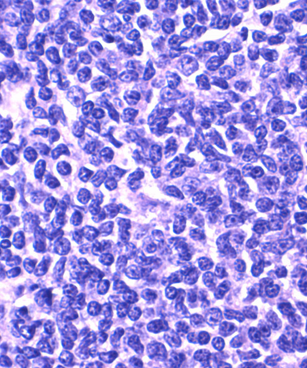 05 : HemMantle Cell Lymphoma
